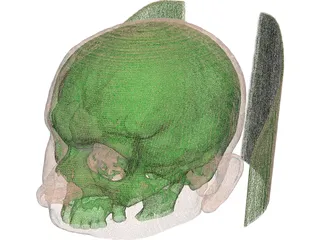 Human Skull InVesalius 3D Model